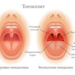 Иллюстрация к материалу «Что такое катаральная ангина?»
