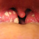 Иллюстрация к материалу «Что нужно знать о герпетической ангине?»
