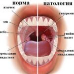 Иллюстрация к материалу «Симптомы и лечение гнойной ангины»